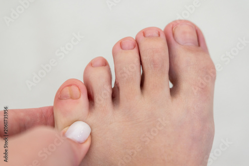 Εκτύπωση καμβά Woman touching her deformed double little toe