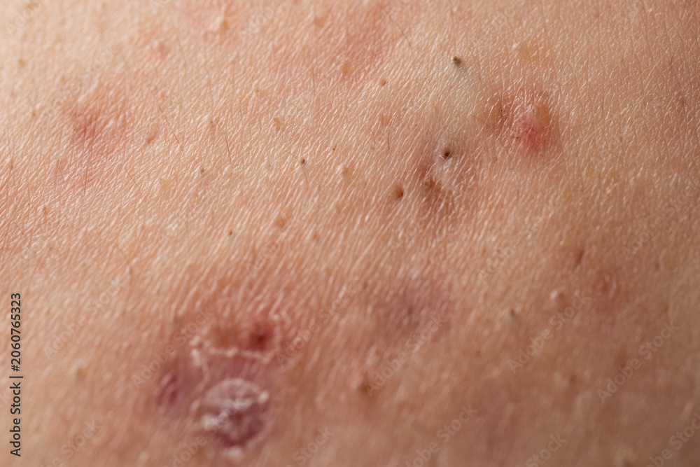 Fototapeta premium Pimple on inflamed body acne. Pimple with red skin irritation. Pimple near visible pores. Pimple in medical macro detail.