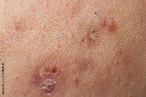 Fotografija Pimple on inflamed body acne