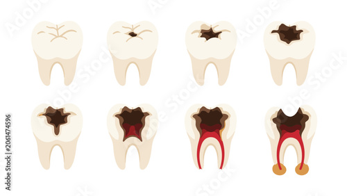Φωτογραφία Vector diagram showing stages of tooth decay progression