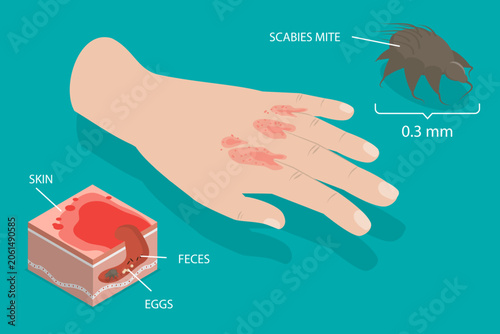 Фотография 3D Isometric Flat Vector Illustration of Scabies, Scabies-Causing Parasite