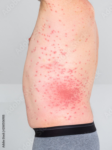 Hautausschlag an der Hüfte, allergische Reaktion, ausgelöst durch die Raupen des Eichenprozessionsspinner