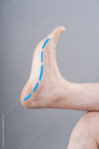 Foto Flat feet or pes planus concept