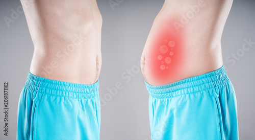 Before and after bloating. Normal flat belly versus swollen stomach with red gas bubbles graphic. Digestion, flatulence and gut health medical concept