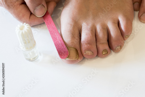 Bild auf Leinwand Close-up view of a hand using a pink emery board or nail file on a discolored big toenail, with a white bottle of medical treatment standing nearby