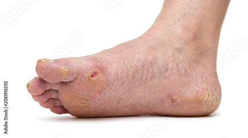 Diabetic foot ulcer and skin complications close-up. Chronic wound, neuropathy or peripheral artery disease medical concept. Isolated on white. AI generated.