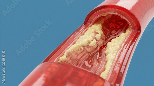 3D rendering of cholesterol plaque inside a red artery on blue background