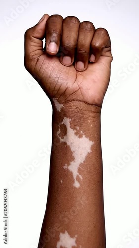 Close-Up of Vitiligo Skin Condition on Hand Against Solid White Background for Medical and Health Awareness Content