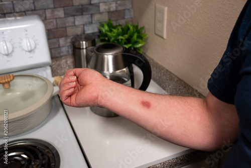 Burn mark on forearm after contact with hot kettle, close view of a household kitchen injury near an electric kettle