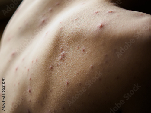 Fotografie Horizontal view of child back showing chickenpox virus rash, close up of skin infection with red itchy spots, inflamed varicella blisters and pimples on patient body
