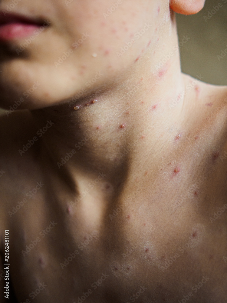 Fototapeta premium Vertical photo of viral chickenpox rash on child body, close up of skin infection with red itchy spots, inflamed varicella blisters and pimples on neck, chest and chin of patient.