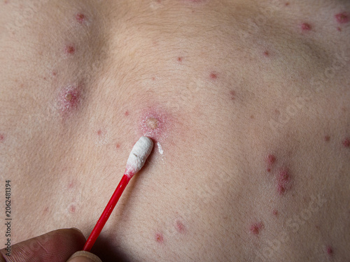 Fotografie Horizontal close up of medical cotton stick applying white zinc lotion on chickenpox virus skin rash, treating painful red spots, inflamed blisters and itchy varicella pimples on body