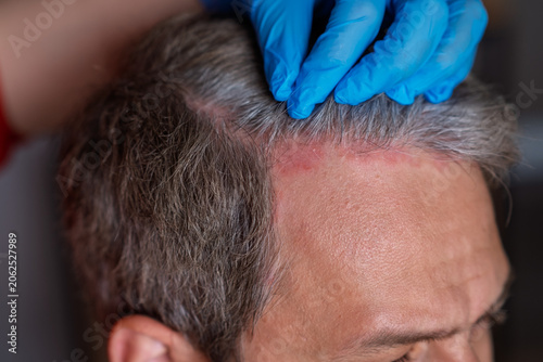 Canvas Print Close-up of man with psoriasis on scalp being examined by a healthcare professio