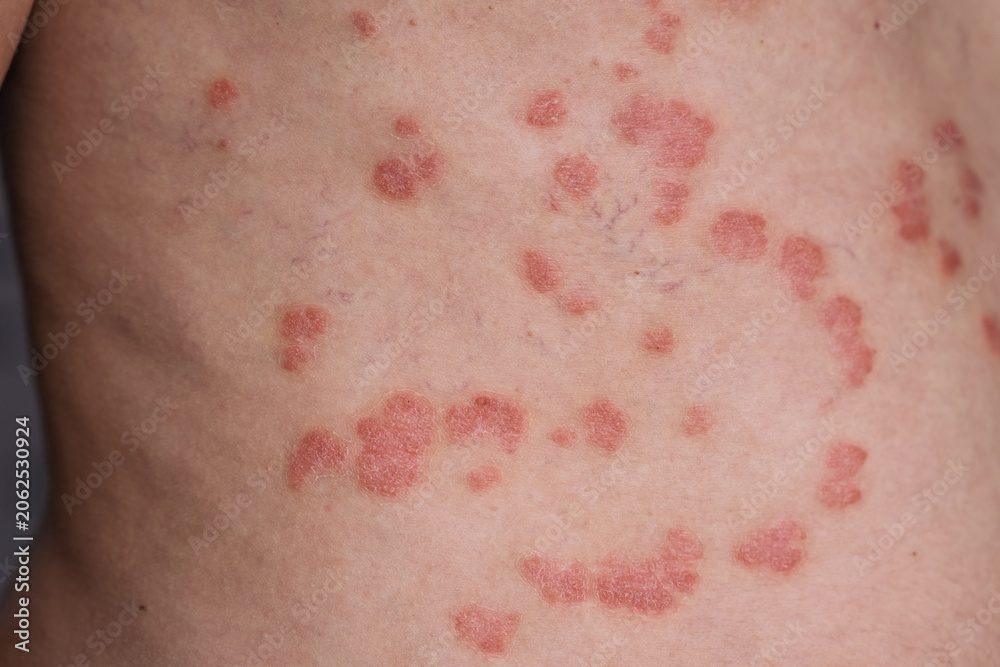 Fototapeta premium Close-up view of psoriasis on a human back, displaying red patches and lesions with visible skin texture and variations in color and surface
