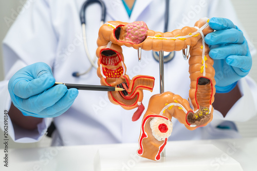 Fotografie Colorectal cancer, doctor holding intestine colon human anatomy model