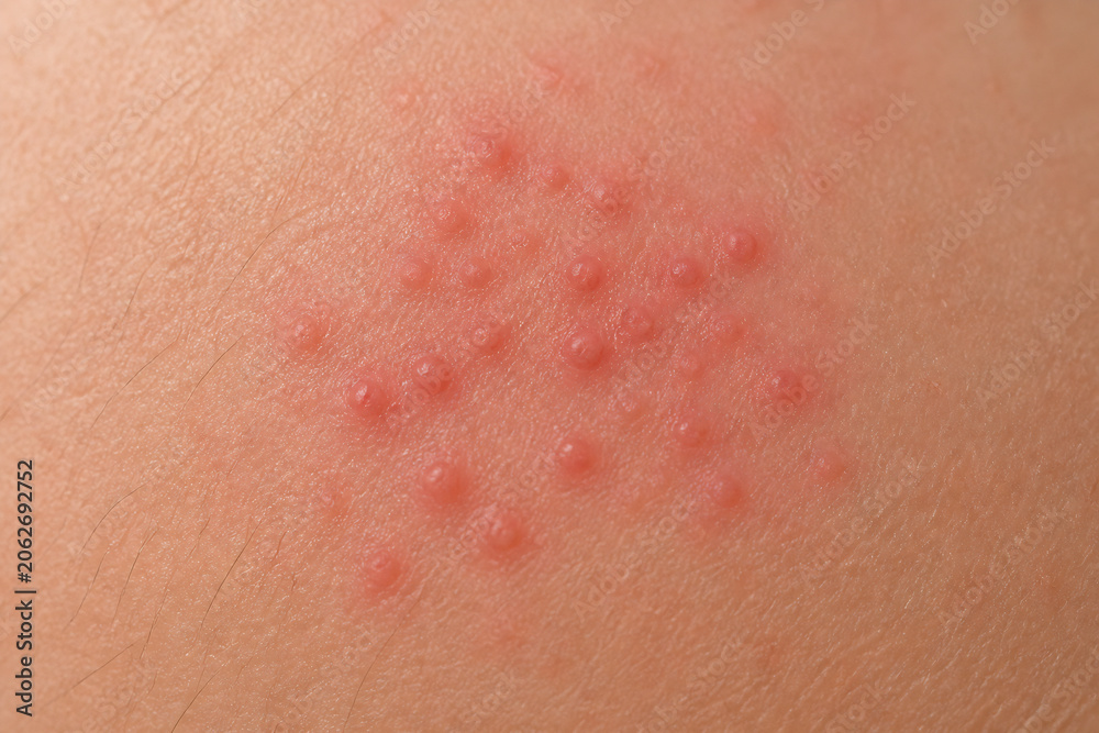 Fototapeta premium A close-up of skin exhibiting multiple small, red bumps or rash spots.