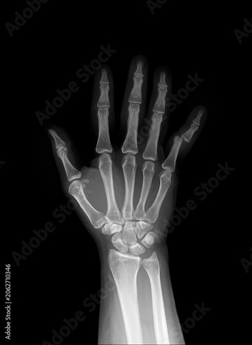 X-ray of human hand showing dislocation of the little finger (fifth finger), AP view on black background. Medical radiograph of bones, joints, metacarpals and phalanges for radiology.