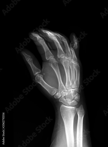 X-ray of human hand showing dislocation of the little finger (fifth finger), Oblique view