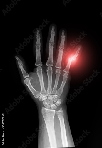 X-ray of human hand showing dislocation of the little finger (fifth finger), AP view on black background. Medical radiograph of bones, joints, metacarpals and phalanges for radiology.