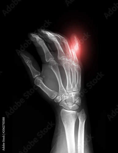 X-ray of human hand showing dislocation of the little finger (fifth finger), Oblique view