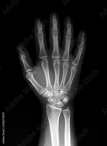 X-ray of human hand and wrist on black background, anteroposterior (AP) view .