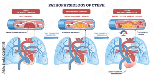 Canvastavla Pathophysiology of CTEPH depicts embolus becoming organized thrombus, narrowing
