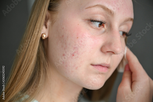 Fotografie Young woman with acne-prone skin removing makeup and cleansing face with cotton pad