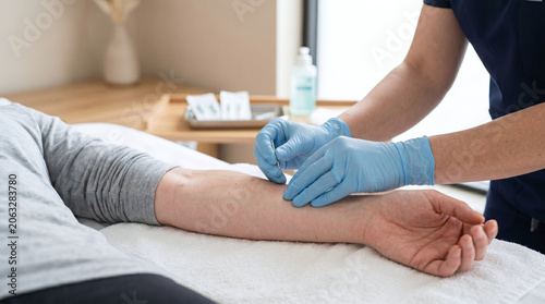 A healthcare professional applies acupuncture needles to the arm of a patient. The practitioner wears blue gloves and is focused on the procedure.