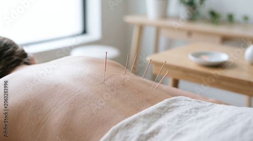 A close-up of a person's back with acupuncture needles inserted. The setting is a calm room with natural light and minimalistic decor.