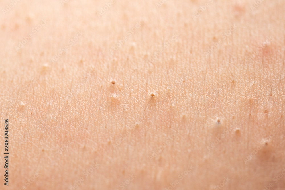 Fototapeta premium Acne on skin closeup photo. Skin inflammation with whiteheads and acne detail. Close up epidermis with inflamed follicles and acne. Detailed skin with acne.
