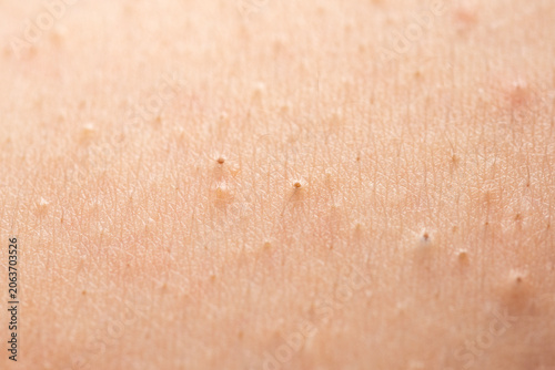 Photography Acne on skin closeup photo