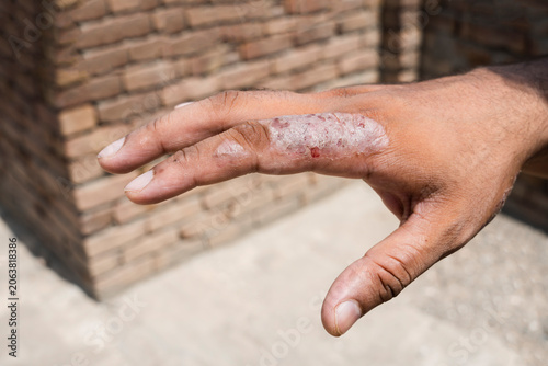 Εκτύπωση καμβά Hand showing psoriasis skin condition on finger with psoriasis dermatology condi