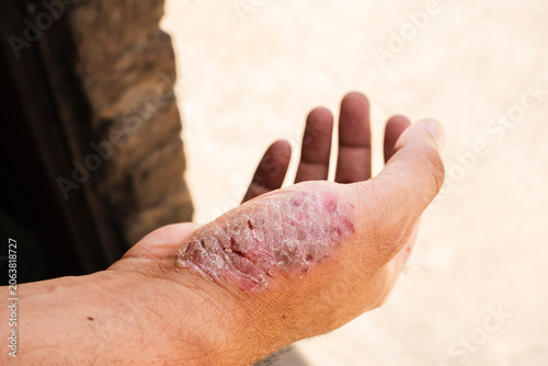 Medical close up of inflamed skin rash on hand with dermatitis inflammation psoriasis irritation dermatology condition