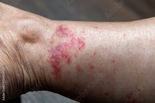 Red rash on the interior ankles of a woman with a shallow depth of field