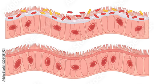 Tableau sur toile Comparison of healthy intestinal epithelium and epithelium with bacterial infect