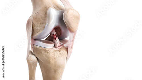 ACL tear knee joint medical 3D anatomy render showing ruptured anterior cruciate ligament with preserved menisci, cartilage, femur and tibia for orthopedic education and patient injury explanation