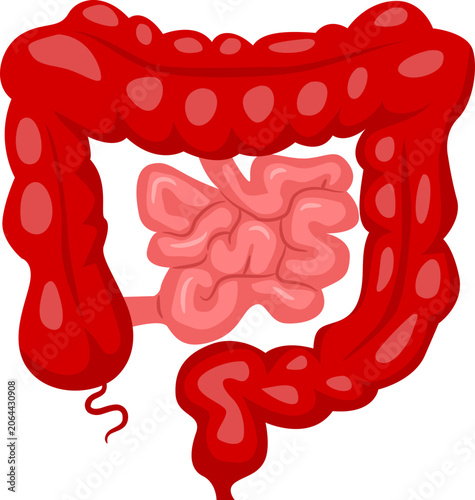 Tableau sur toile Bowel Surgery total proctocolectomy