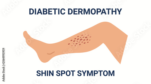 Slika na platnu Diabetic Dermopathy Skin Lesion Shin Spot Symptom Illustration