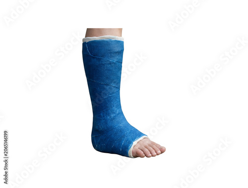 Blue fiberglass leg cast on human foot, medical orthopedic plaster for broken bone recovery, surgical rehabilitation for ankle fracture and injury isolated on Transparent Background