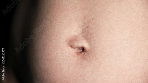 Navel close-up front view. A woman's stomach after pregnancy with stretch marks on the skin. A scar after laparoscopic surgery through the navel. Body part. Postoperative lymphatic edema on a abdomen.