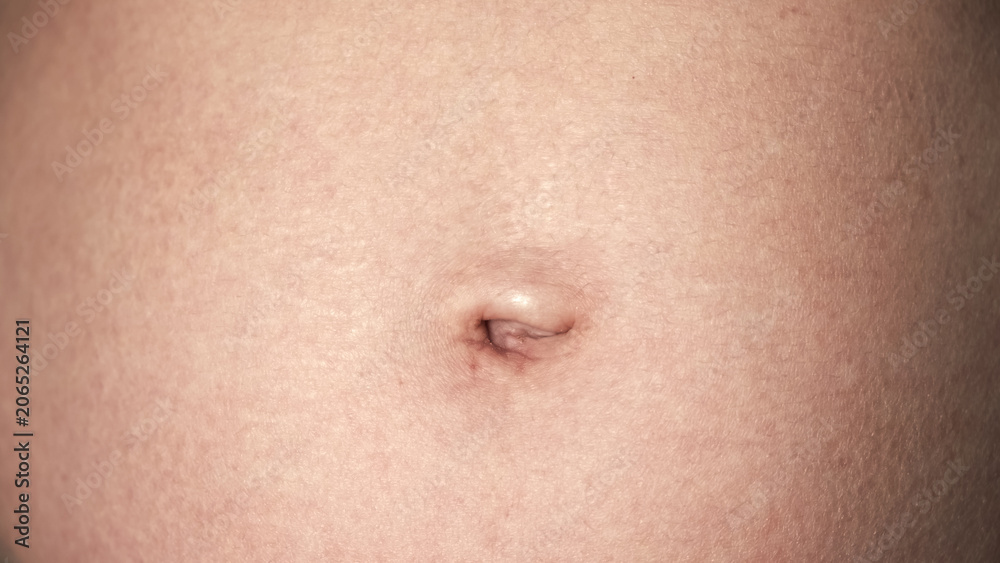 Fototapeta premium Navel close-up front view. A woman's stomach after pregnancy with stretch marks on the skin. A scar after laparoscopic surgery through the navel. Body part. Postoperative lymphatic edema on a abdomen.
