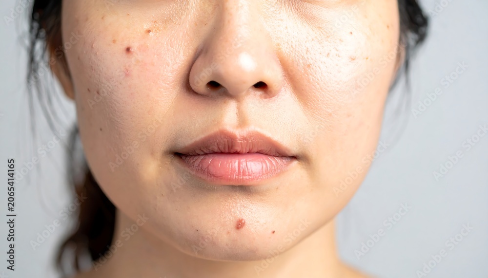 Fototapeta premium Close-up of a woman's face with acne and freckles