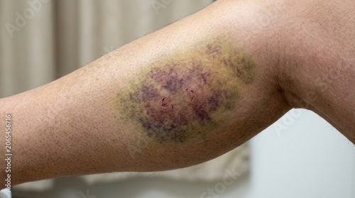 Close-up of a large, purple and yellow bruise on a person's leg, showing skin injury.