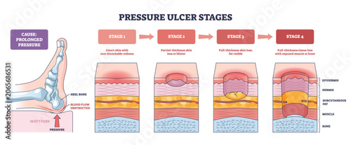 Photos Pressure ulcer stages infographic illustrating progressive skin breakdown from prolonged pressure, shows heel, skin layers, and mattress pressure point