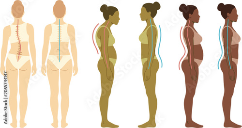 Tableau sur toile Spine posture correction vector infographic showing normal alignment vs scoliosi