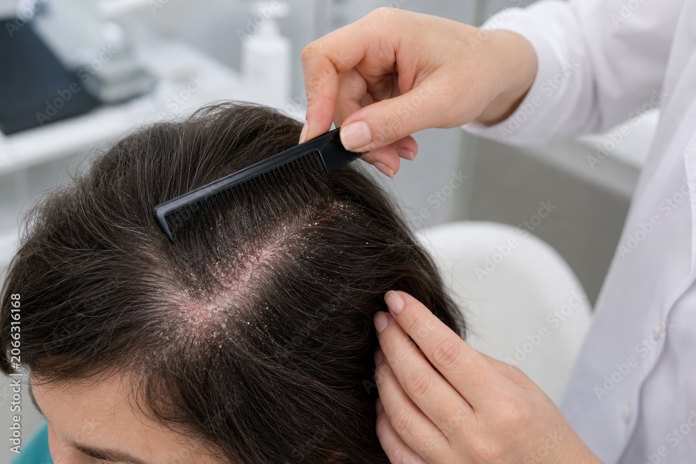 Naklejka premium Dermatologist Using Black Comb to Examine Seborrheic Dermatitis Flaking on Crown of Patient Head in Clinical Setting