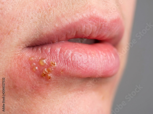 Close up of human lips with cold sores and blisters herpes