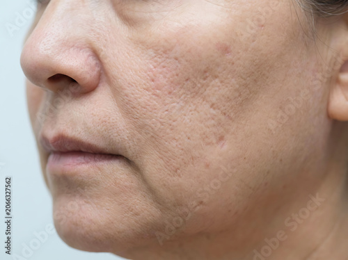 Close up of human skin texture with visible pores and acne scars image