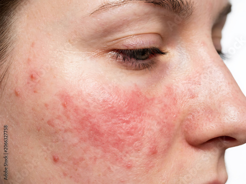 Close up of woman's face with red inflamed skin and acne blemishes image