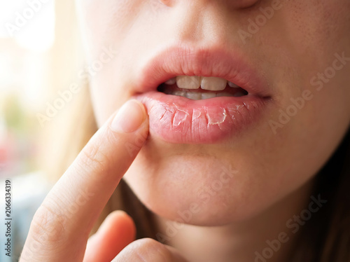 Woman touching cracked dry lips with finger close up chapped skin